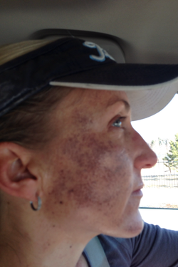 IPL PhotoFacials - Denver, Littleton, Centennial and ...